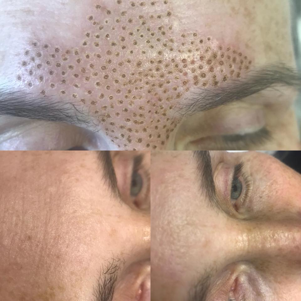 Plasma Pen Treatments The Mulberry Spa