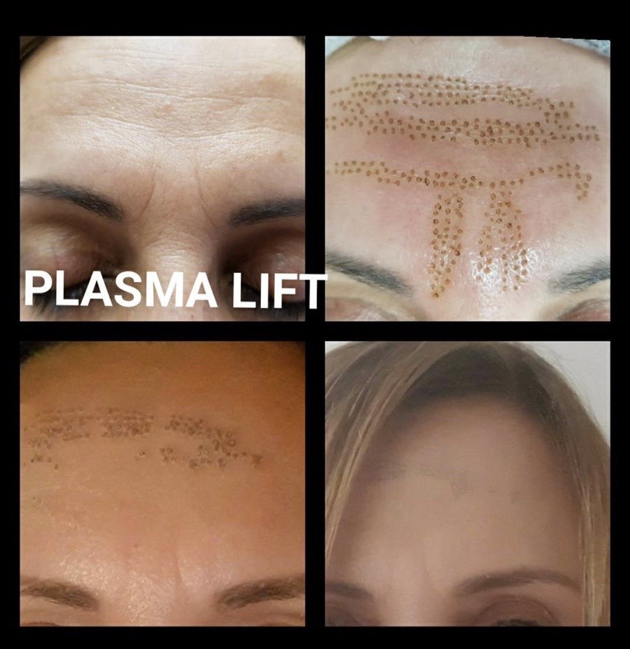 Plasma Pen Treatments The Mulberry Spa