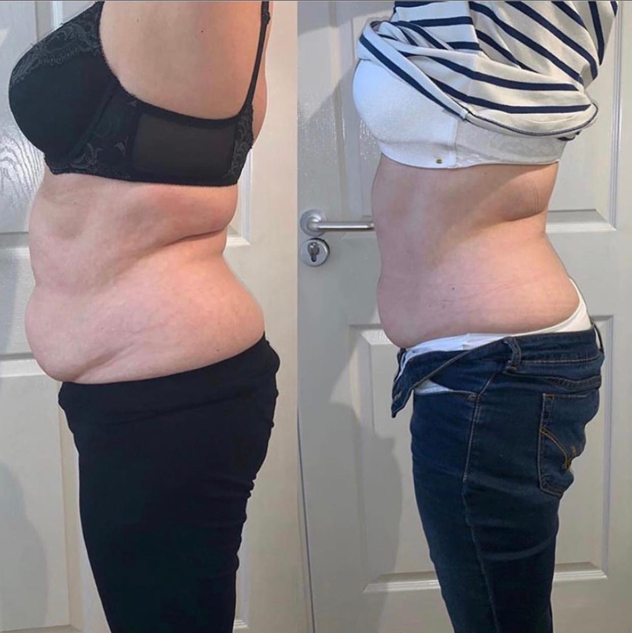 Lipofirm Pro Body Treatments The Mulberry Spa Lipofirm Pro Body Treatments The Mulberry Spa